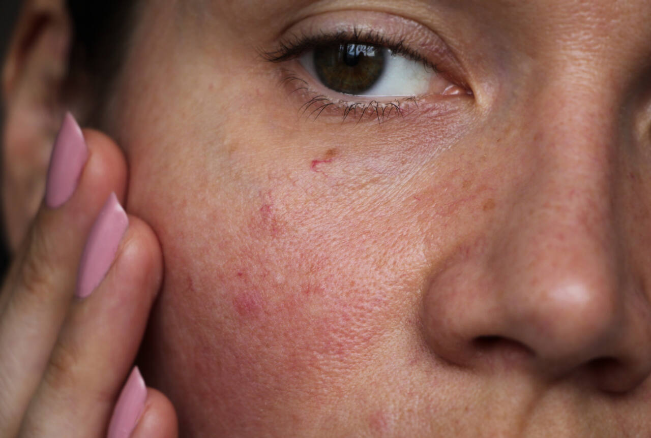 burst capillaries on the girl's face